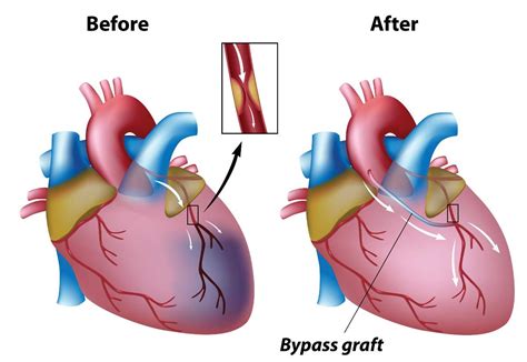 Signs to watch out for coronary bypass graft